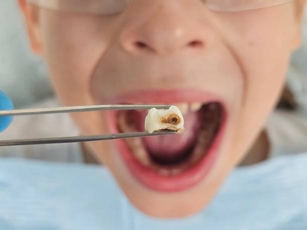 Emergency Dental Filling Replacement in OK